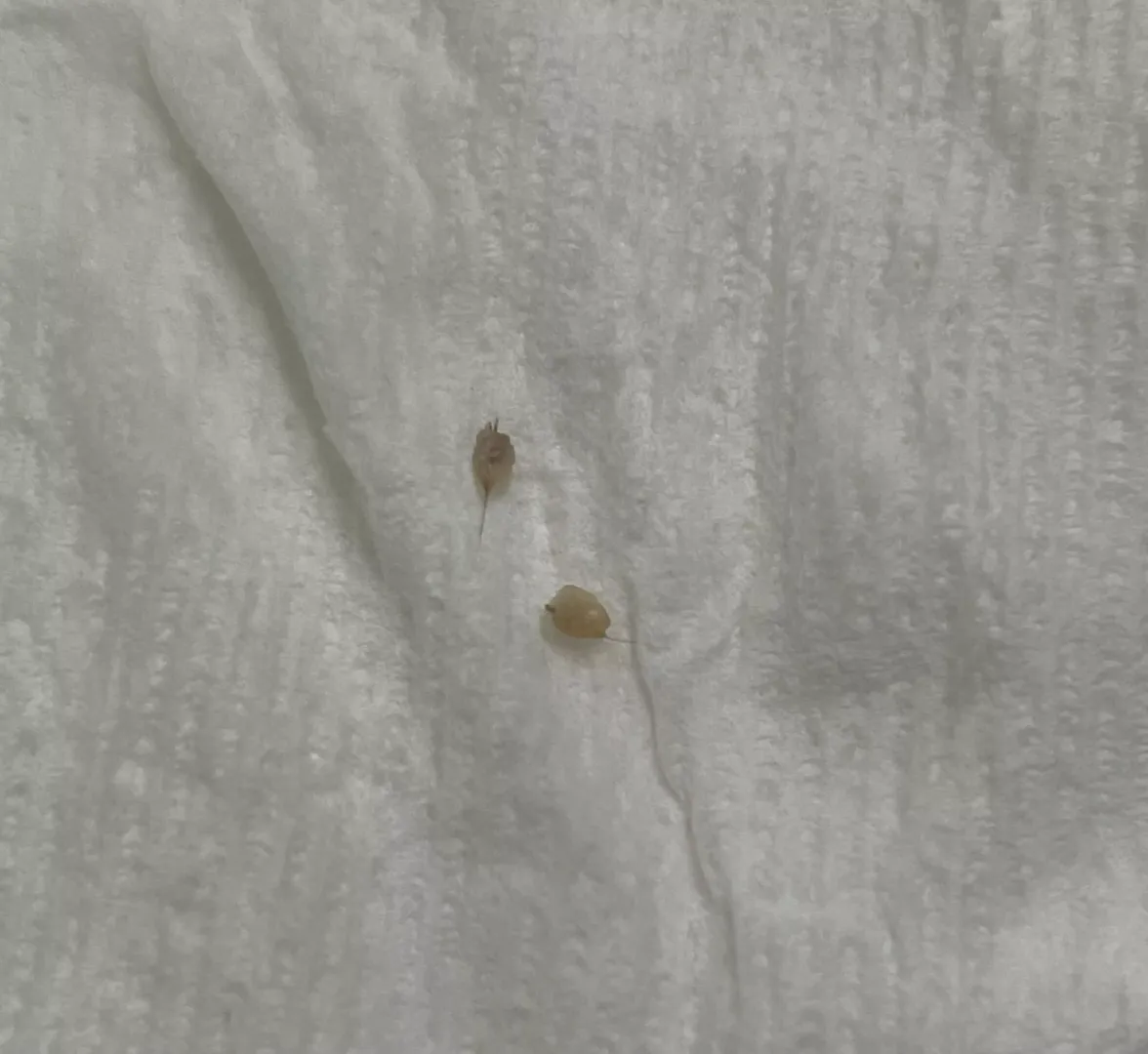 After 4 months of having these two painful small bumps on each of my buttcheeks, I am free