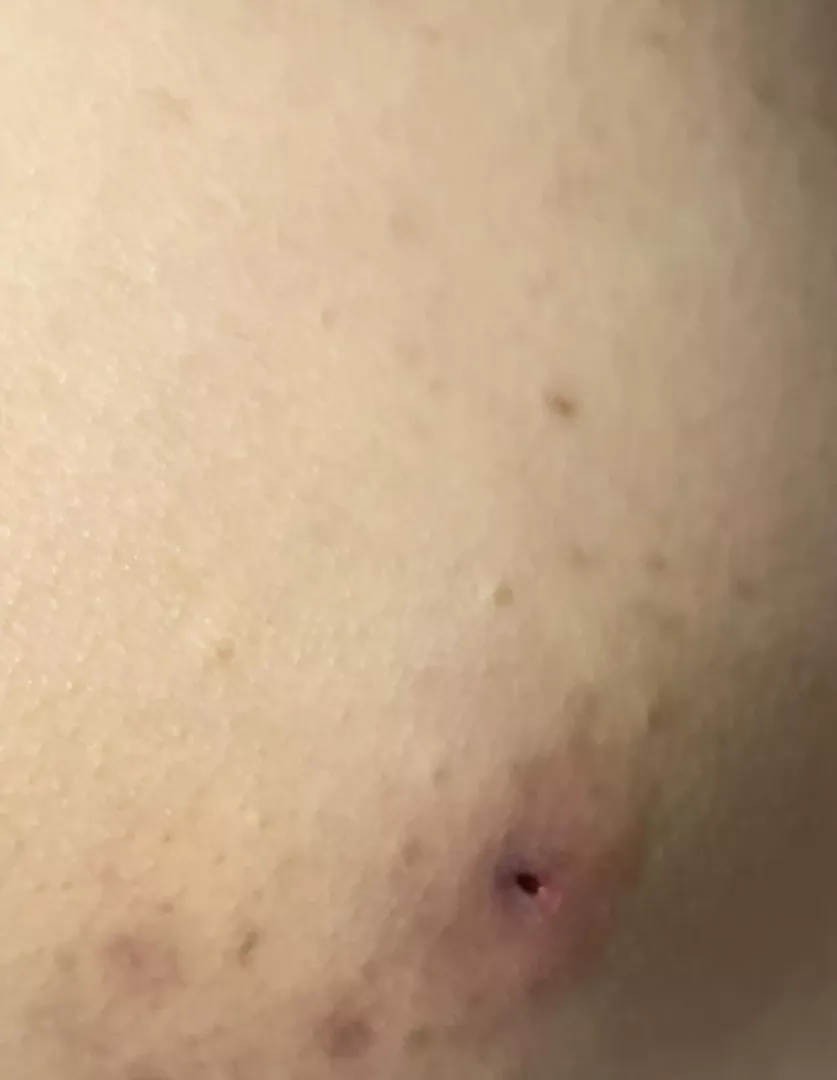 After popping this is what left of it and I wanna ask is this bad or will be healed?