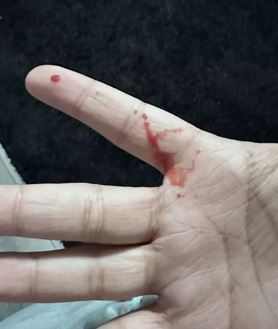 Aftermath of a pimple/boil