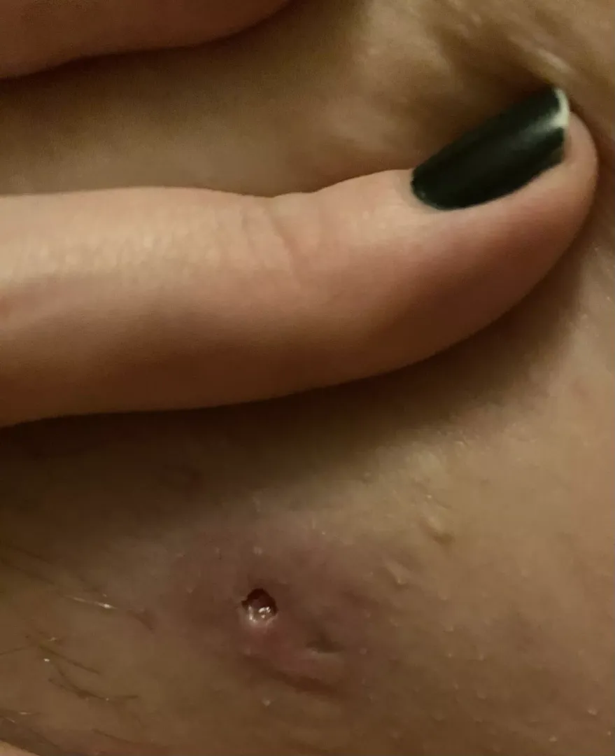 Aftermath of staph infection. I am on antibiotics.