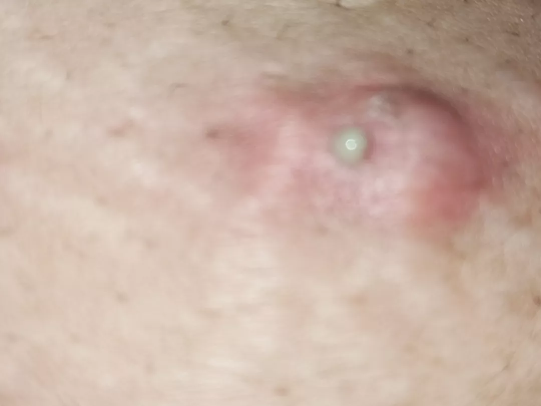 Anyone ever had 2 connecting pimples within a stretchmark? 