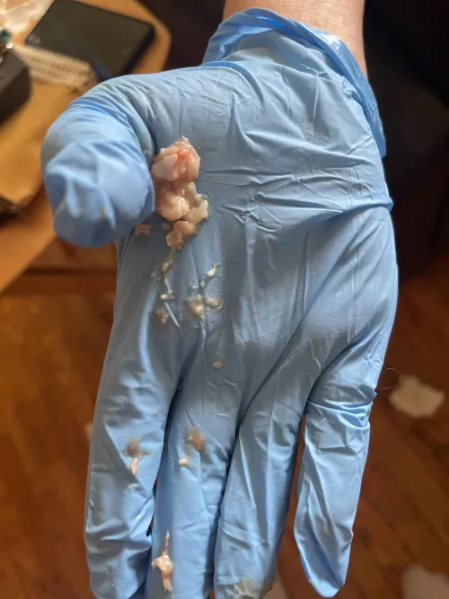 Apparently the doc didn’t drain my cyst all the way