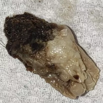 At least decade since belly button cleaned. Not for the weak hearted!