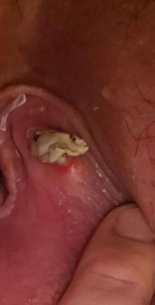 Bartholin's Cyst Wall Coming Out