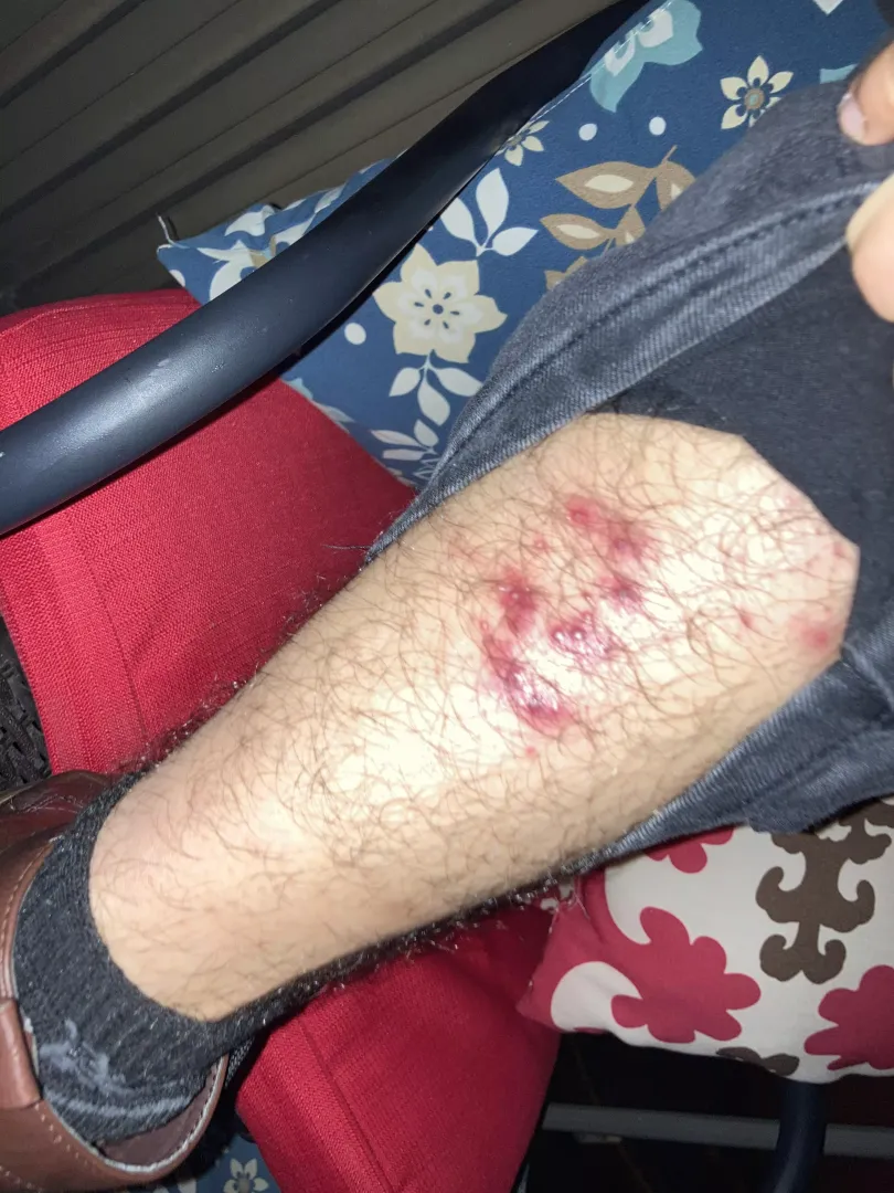 Big patch of pimples appeared suddenly. Could it be monkeypox?