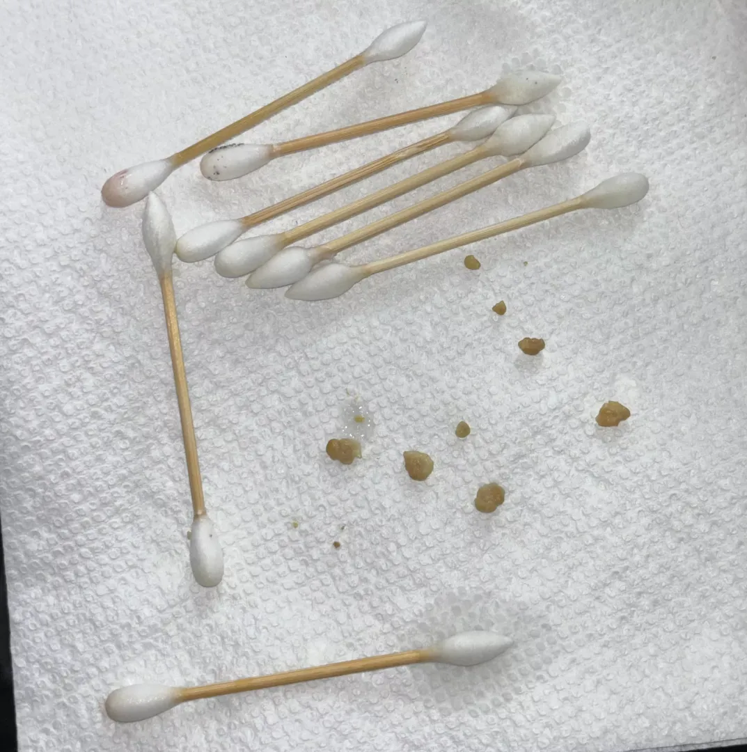 big tonsil stone haul 