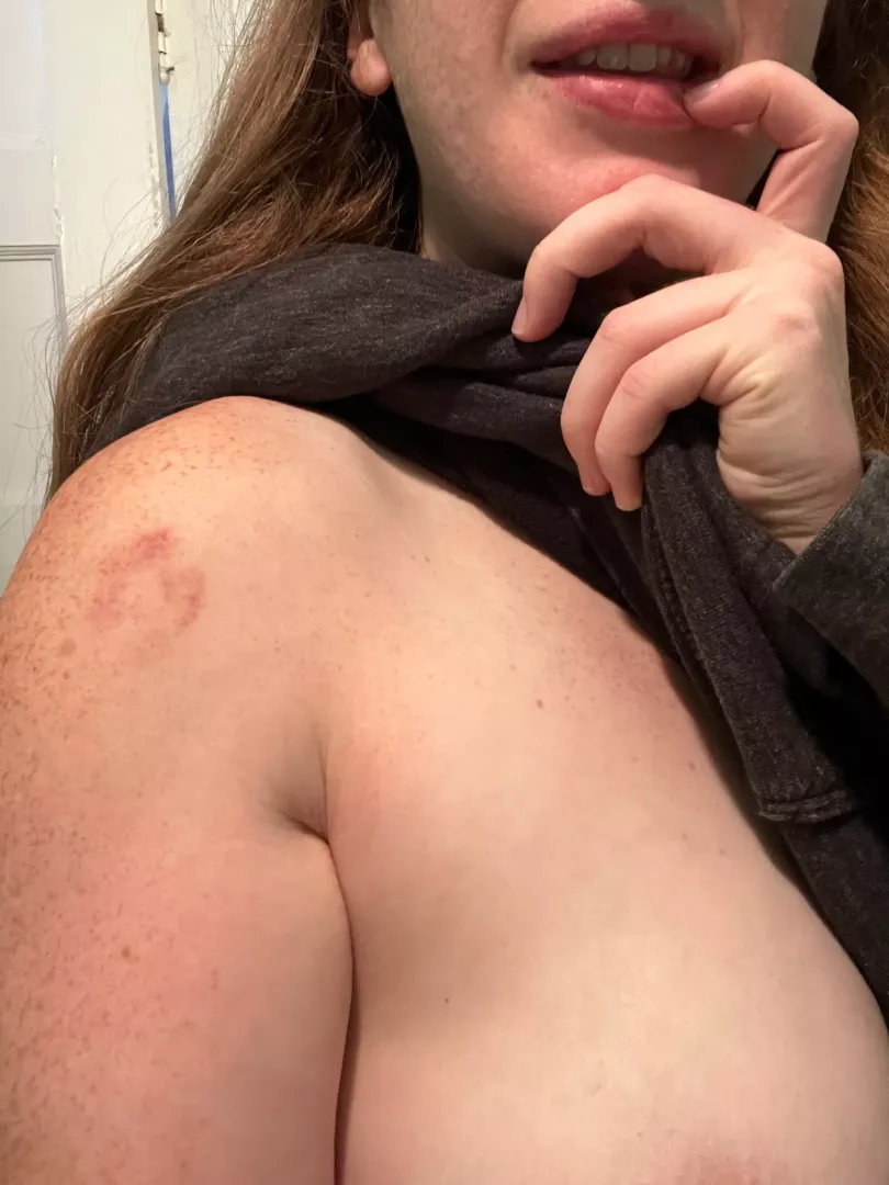 Bite marks and freckles