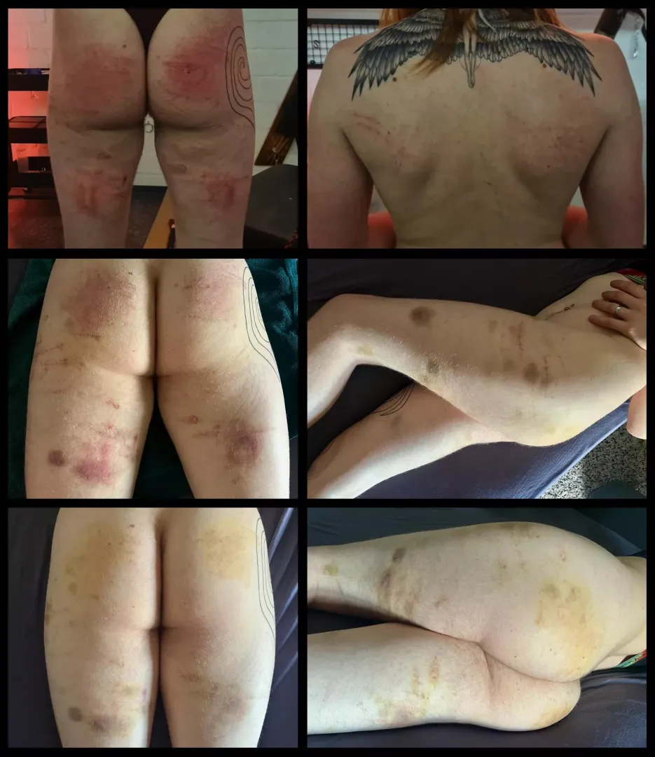 Bruises - The Gift That Keeps on Giving