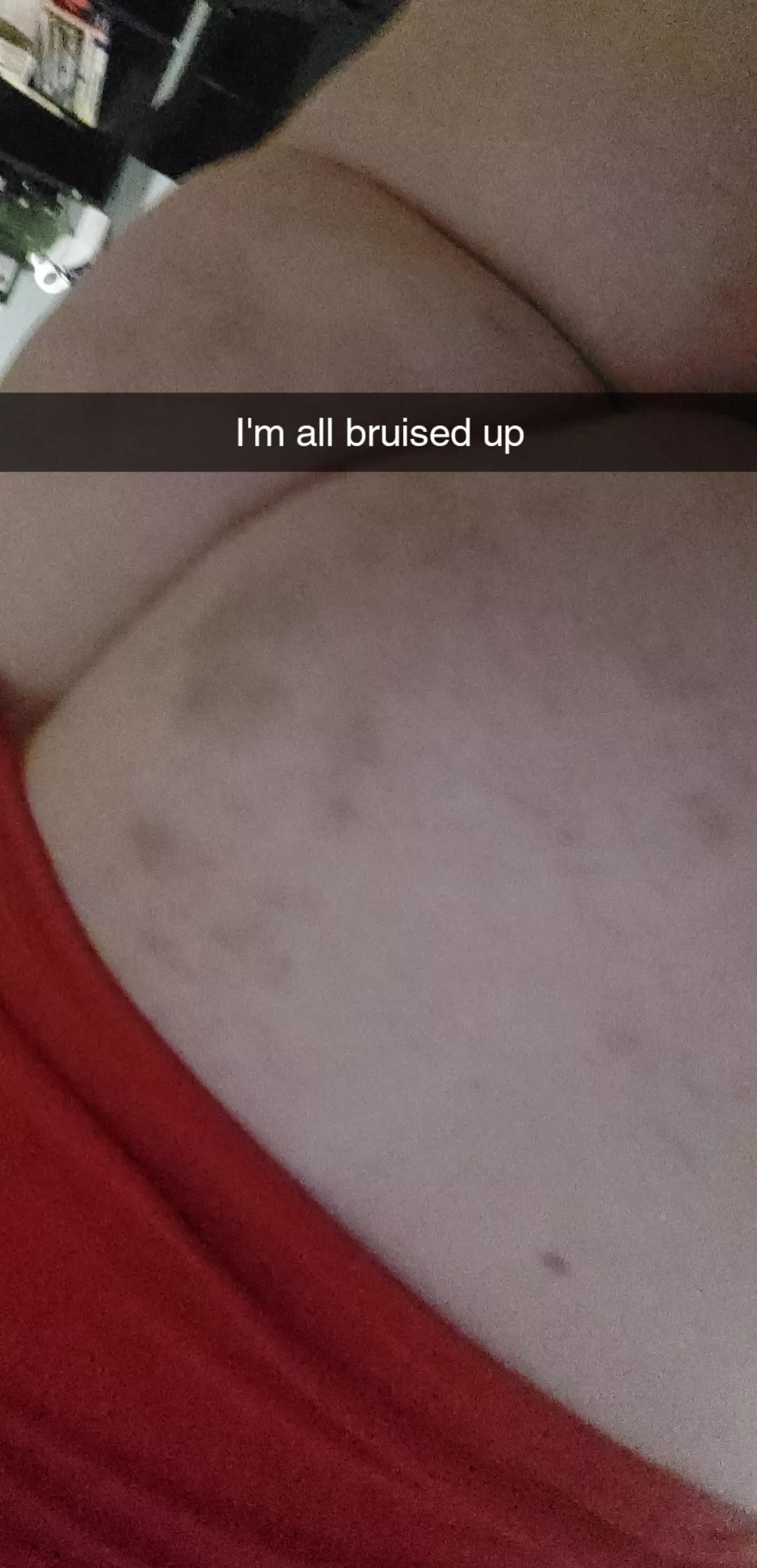 Bruises 🥰🥰🥰