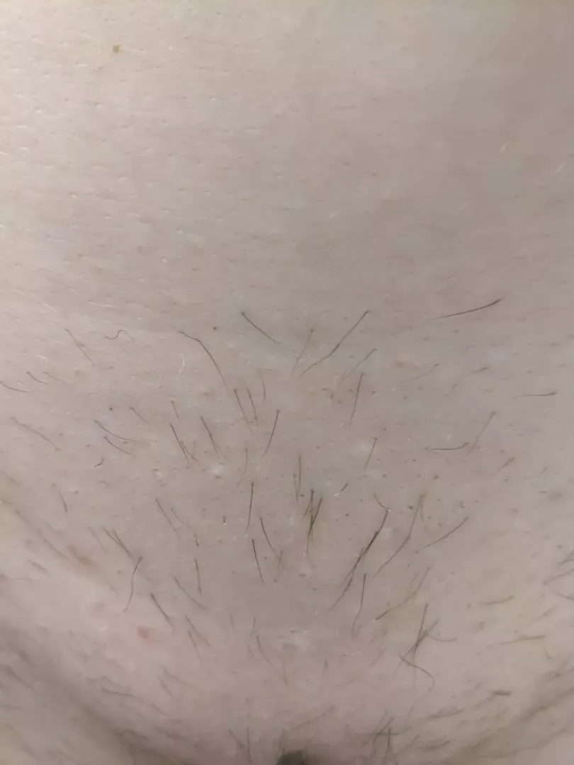 Can I still can a brazilian even if my hair has grown back patchy?