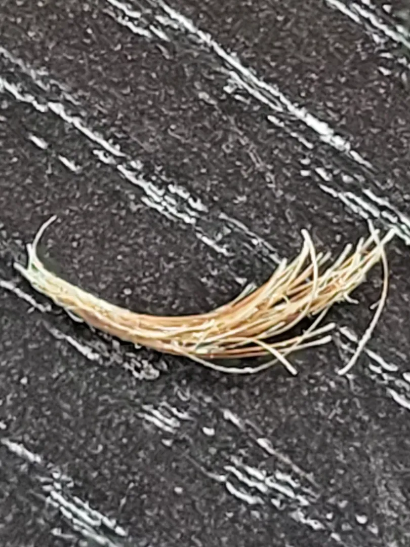 Compound Ingrown Eyelash 3 years in the making