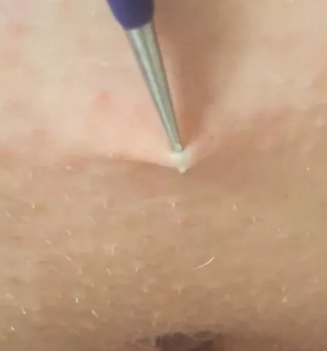 Couldn’t get a good video, not sure what to call this little skin tunnel I found in my pubes