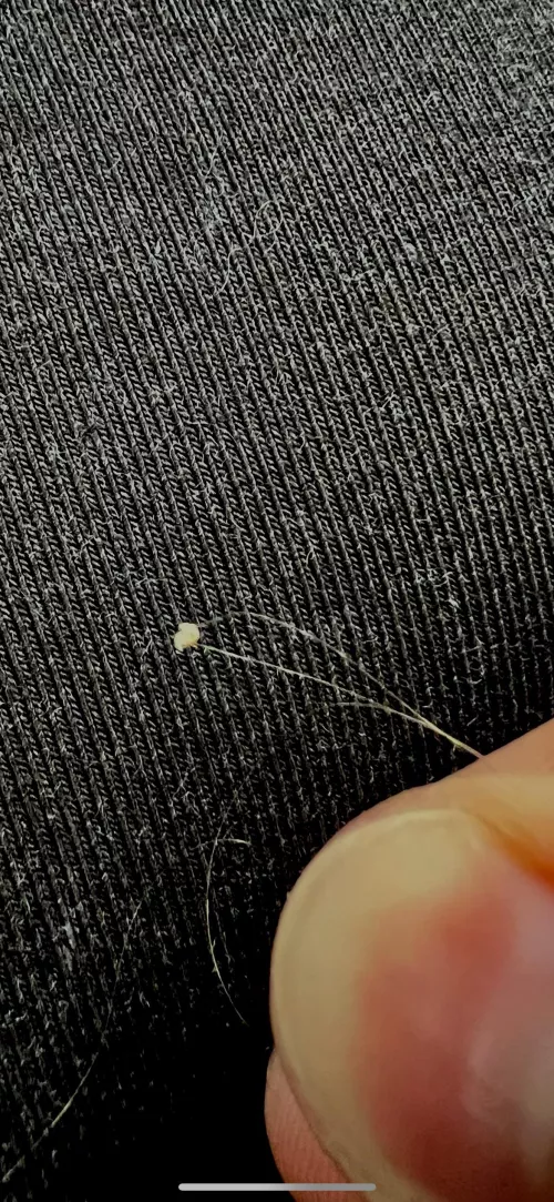 Deep cystic sit i’ve been digging my at in back of my head for 2.5 weeks