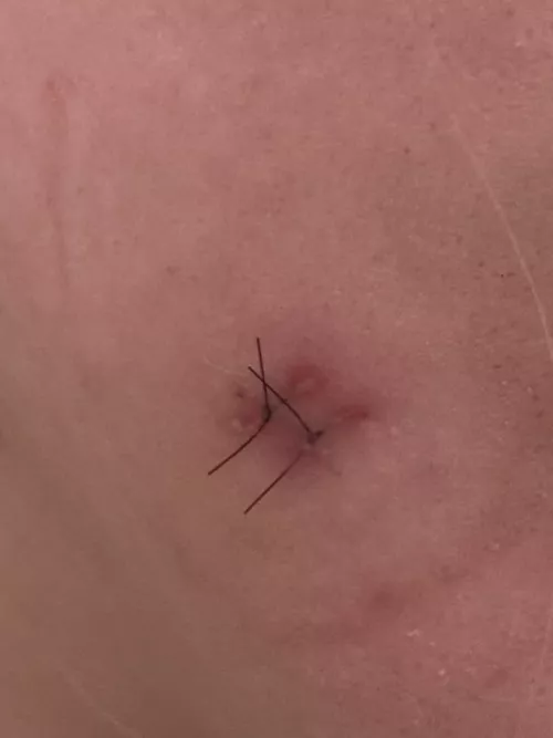 Do my stitches look infected? 