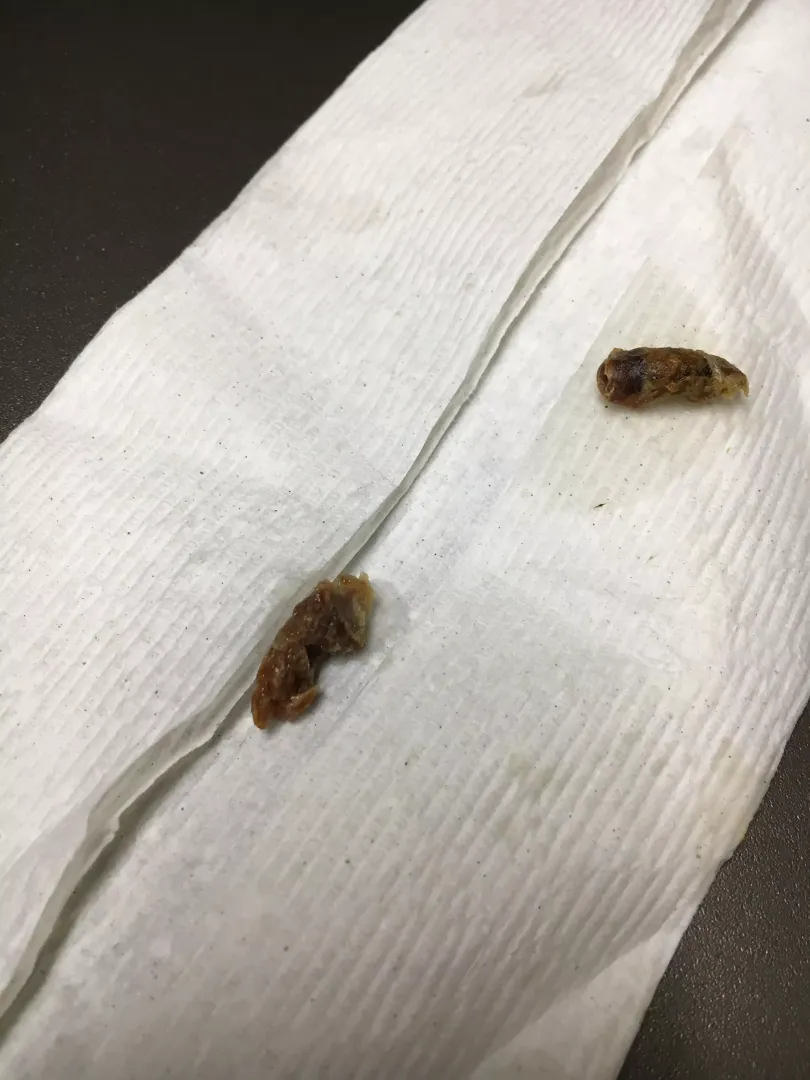 Doctor said some people just produce more earwax than others