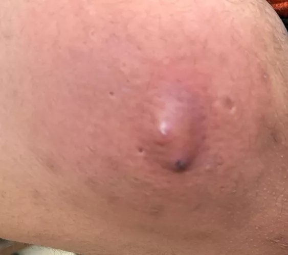 Double headed Hell on my inner thigh