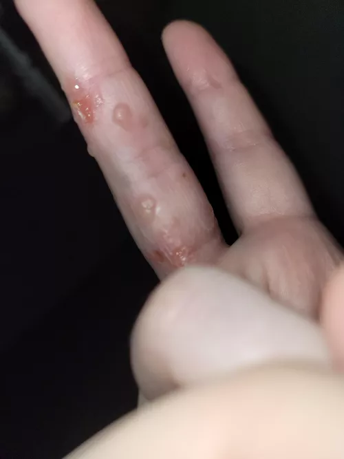 eczema flare up. will probably rupture in my sleep :(