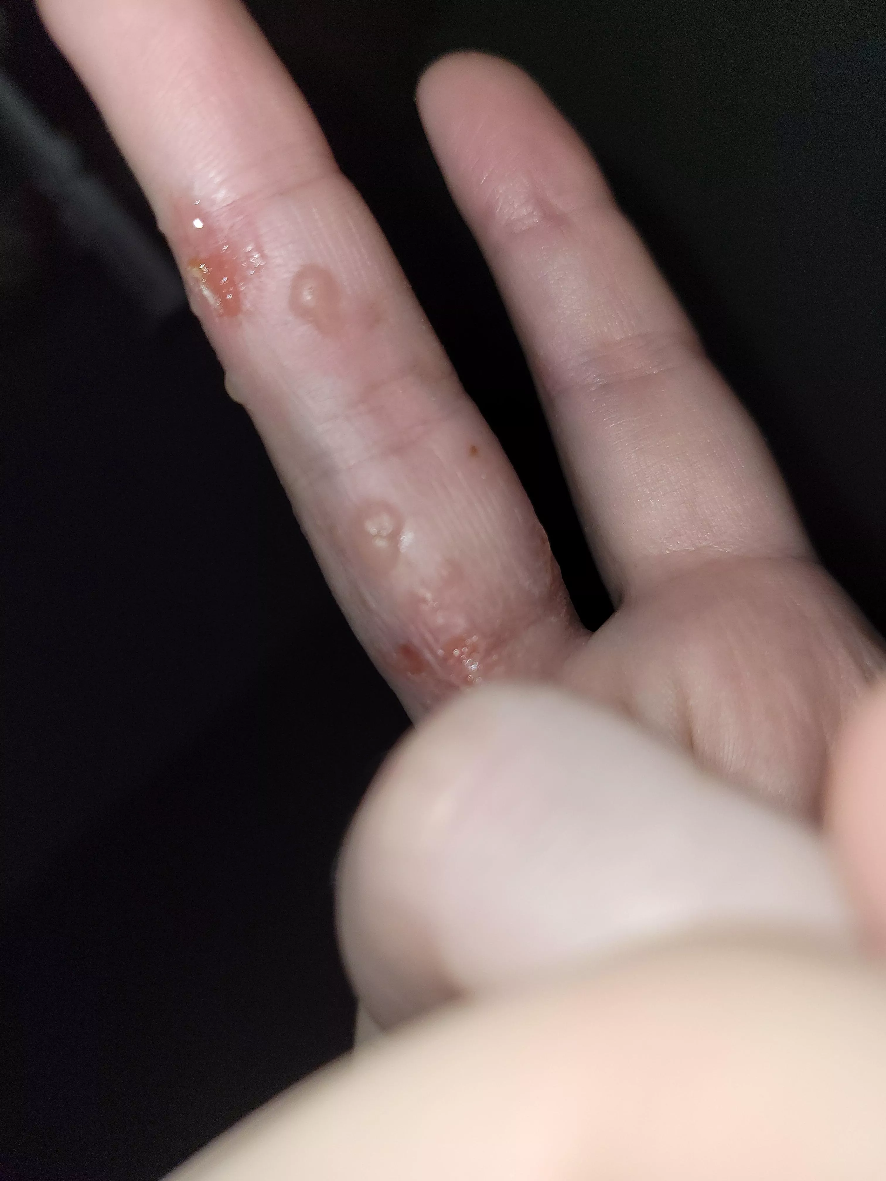 eczema flare up. will probably rupture in my sleep :(