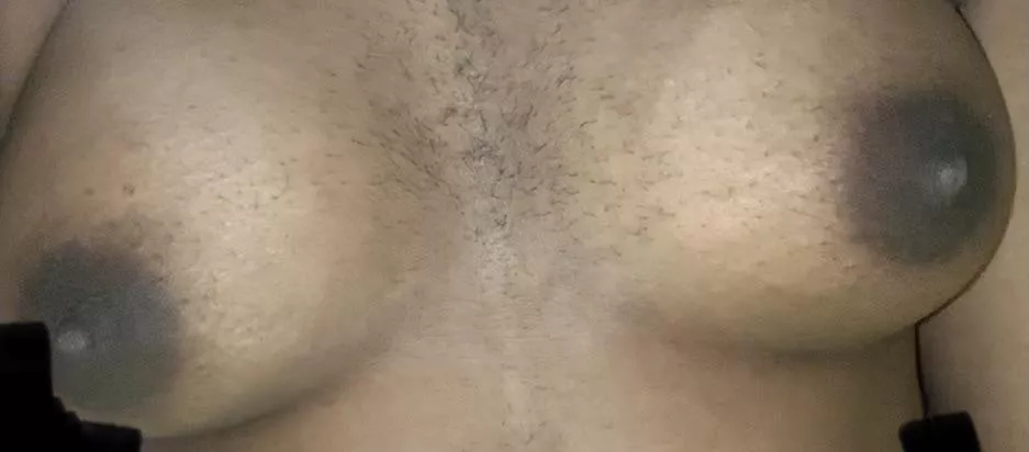(F20, 5’0, 50kg) I’m a woman with hirsutism , which means I grow hair in places and patterns where men usually grow hair. I feel so disgusting. I feel like a man. No one will ever love me. I’ve been called a man all my life.
