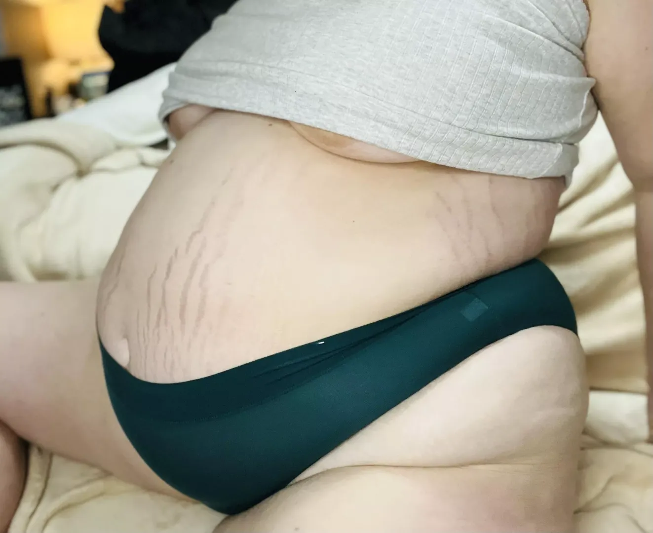 Fat belly, deep stretchmarks