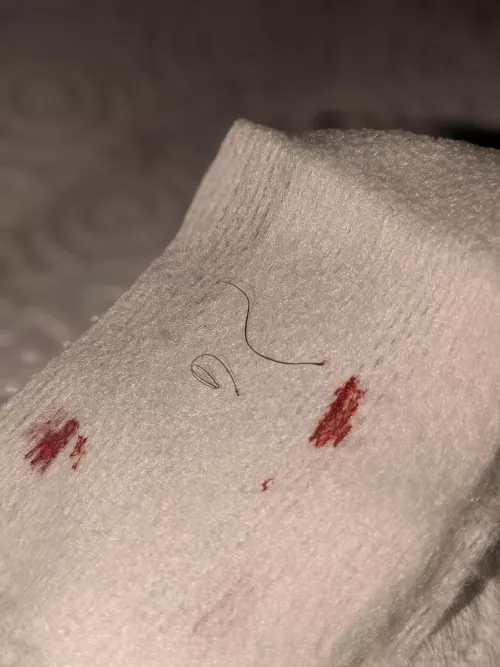 First pop: 3 long ass ingrowns!