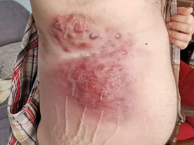 First time,. Forbidden pops, stage 4 skin cancer.