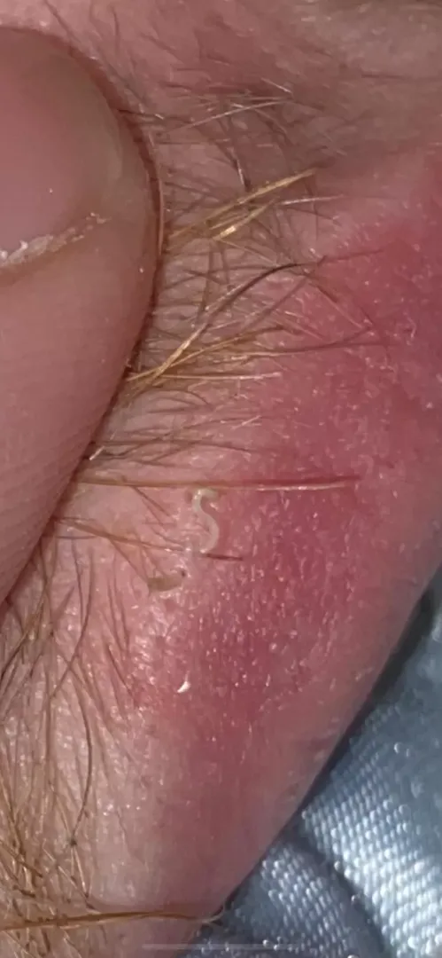 first time poster. 2 distant cousins i squeezed out of my boyfriends lip.