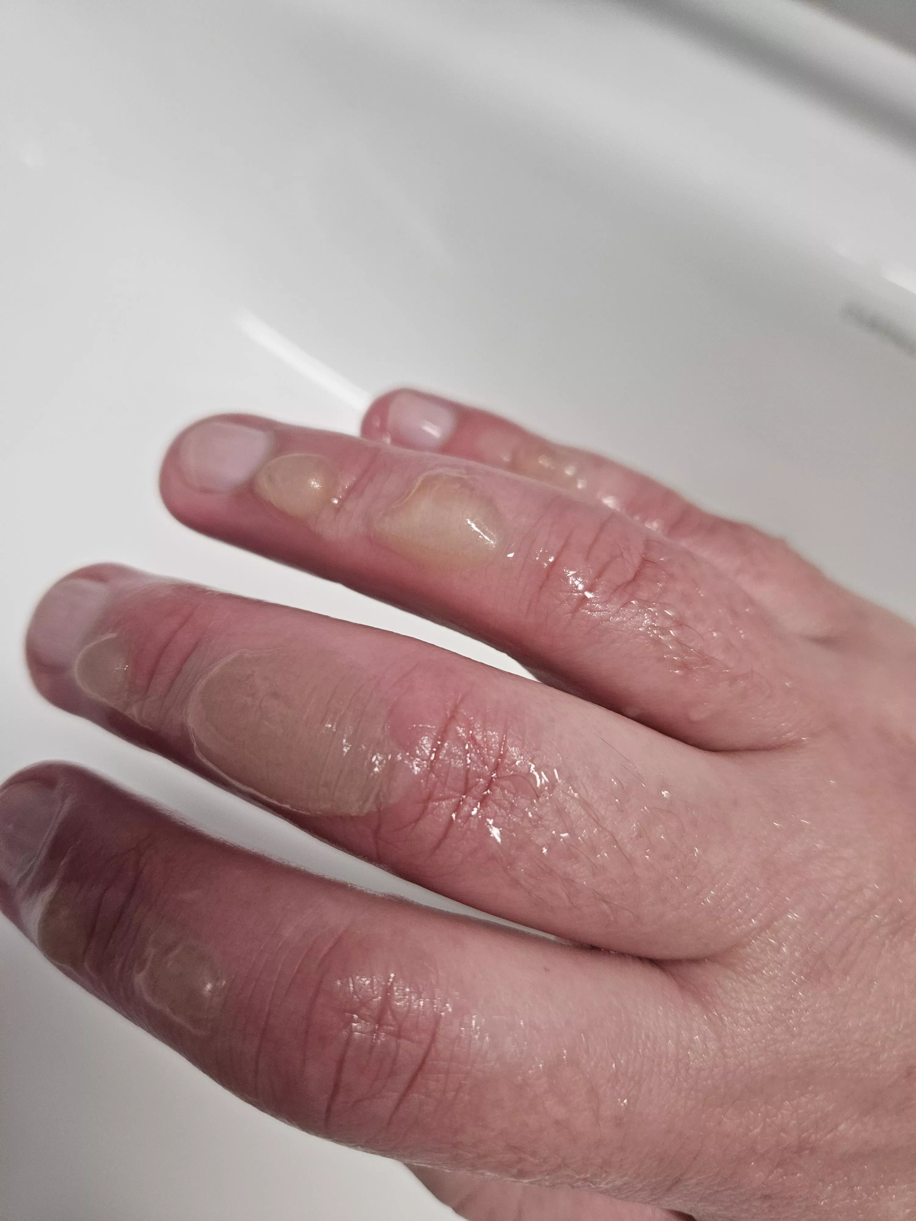 First time poster. Burnt my fingies on a metal tray, fresh out of the oven at work