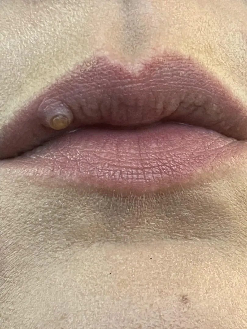 Follow up on this - it was phonemic granuloma!