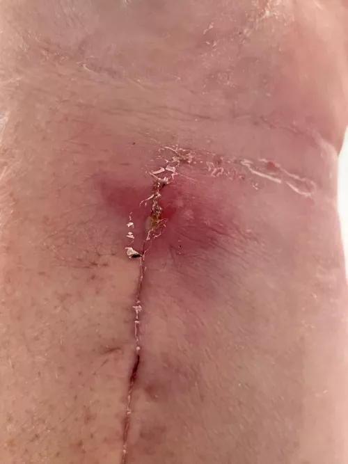 Forbidden pop after surgery to plate my broken wrist. There’s a head!!!