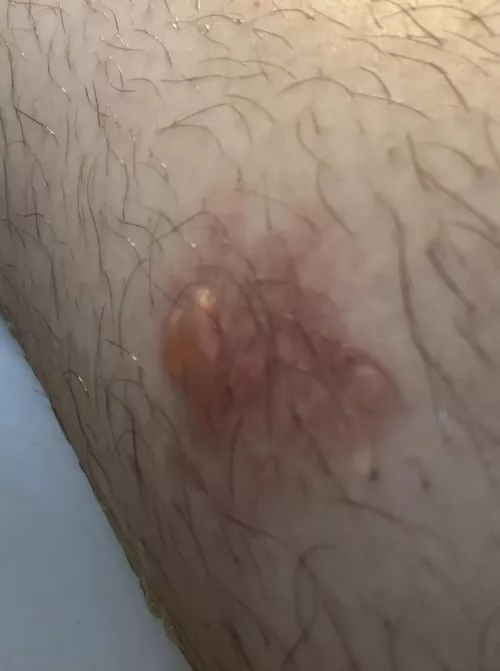 Forbidden pop - juicy leg blister from the tail pipe on my friends bike