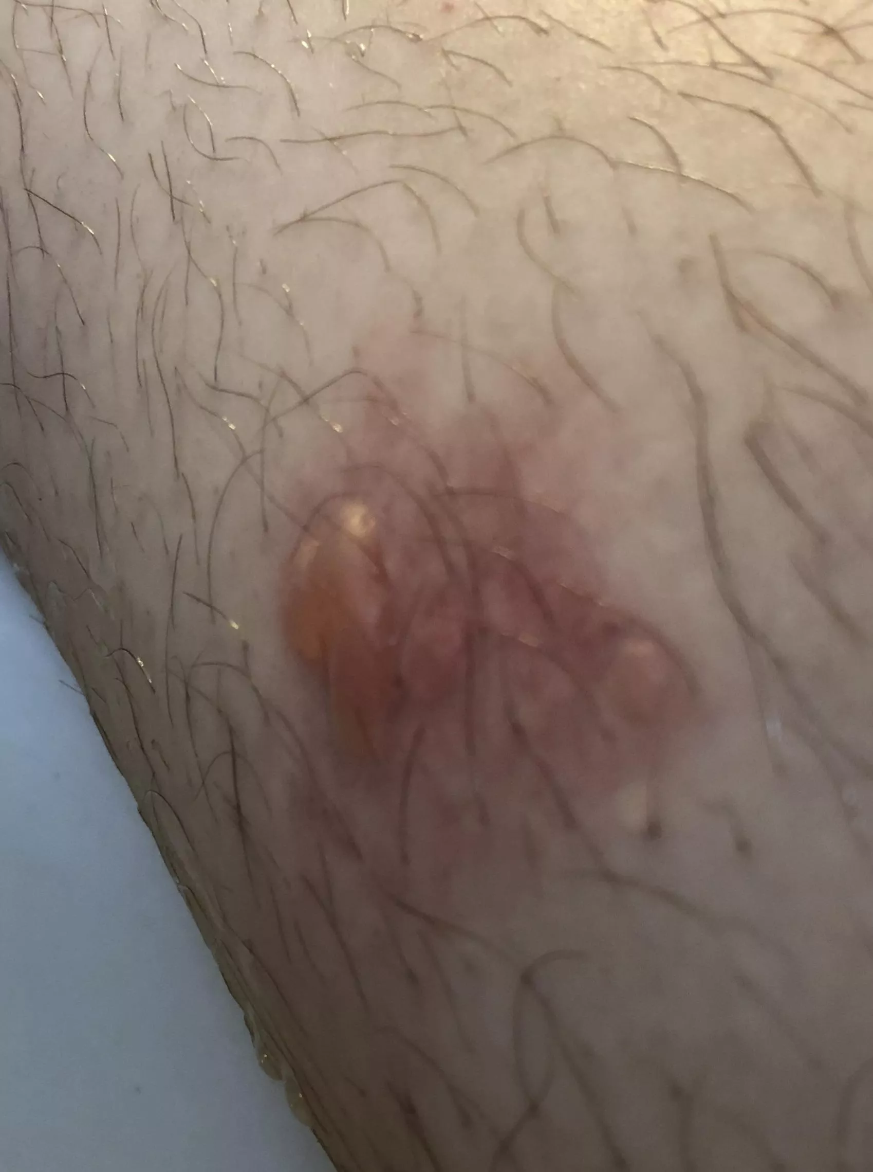 Forbidden pop - juicy leg blister from the tail pipe on my friends bike