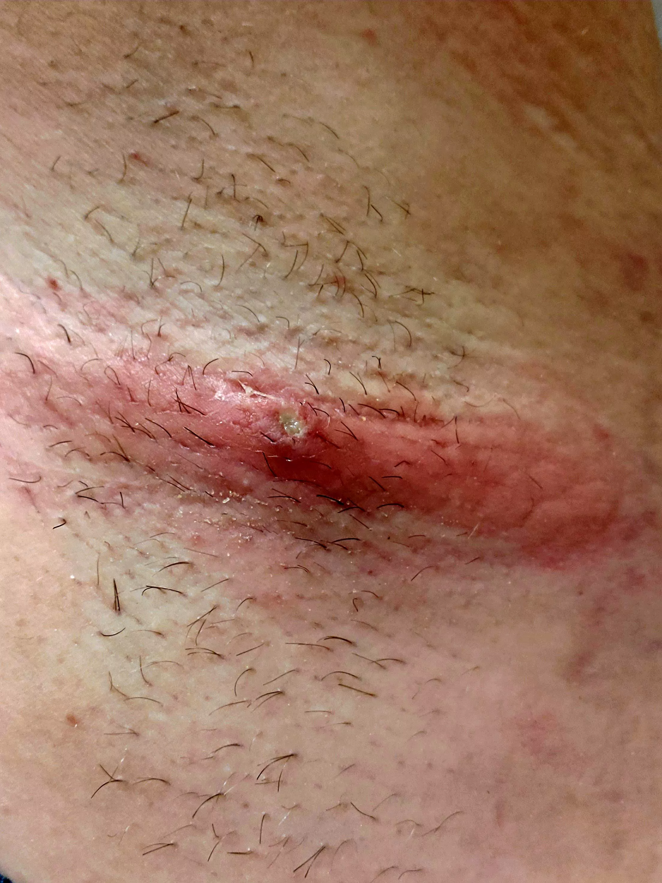 Forbidden pop, MRSA in armpit