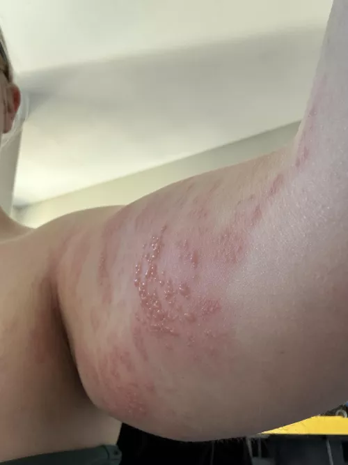 Forbidden Pops- shingles