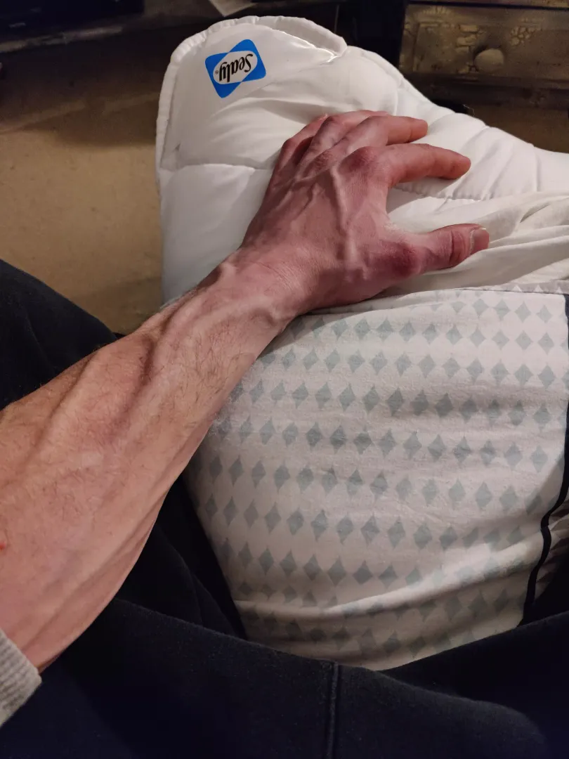 Forearm/hand stoof