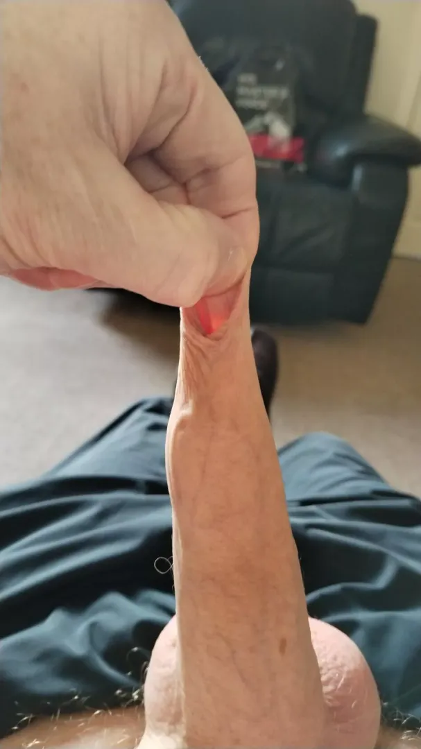 Foreskinstreched