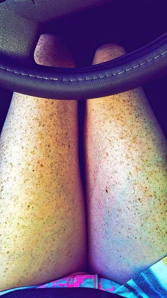 freckle city