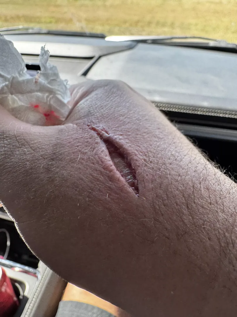 Got bit by a 45