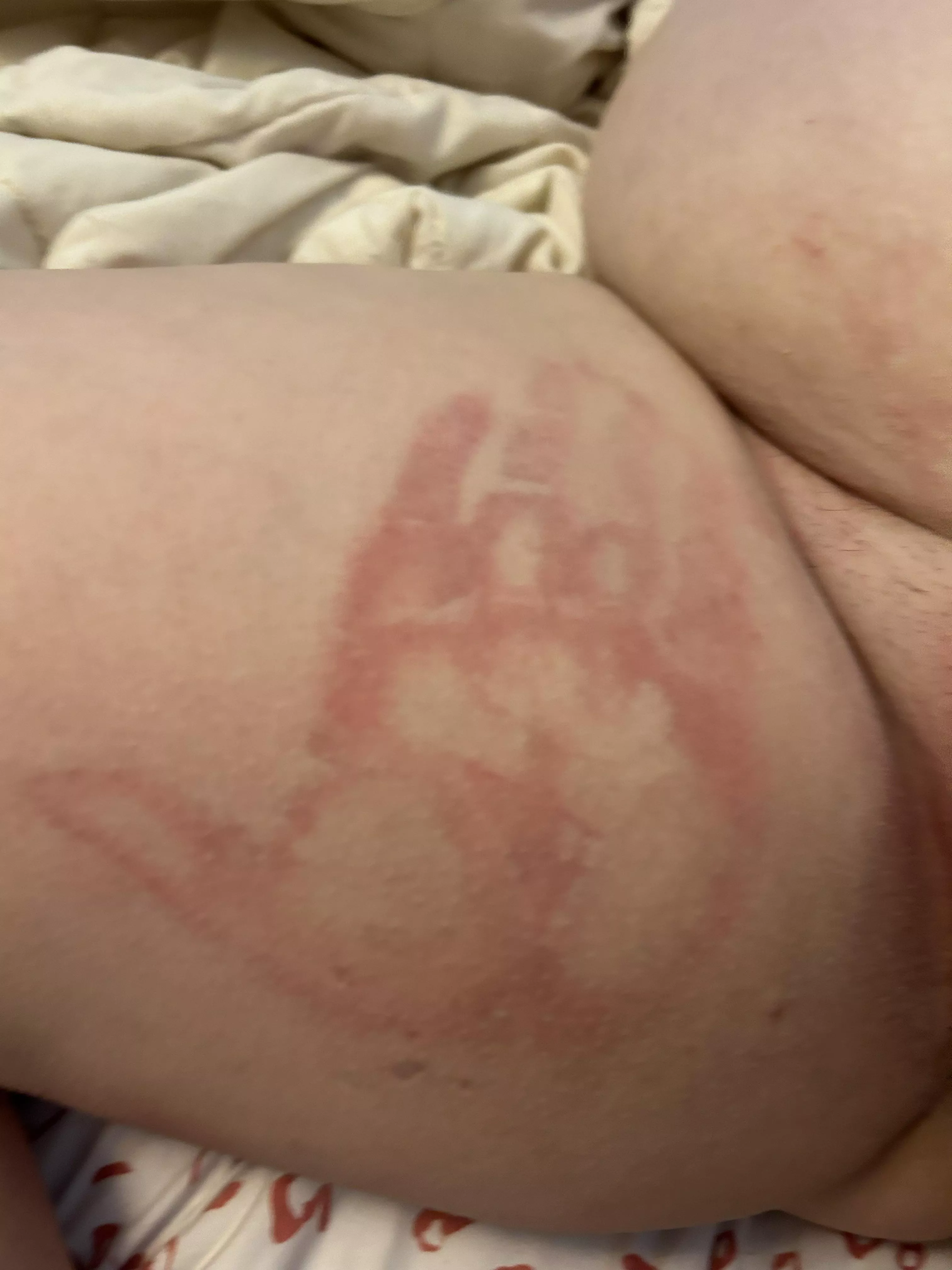 Hand print on my inner thigh