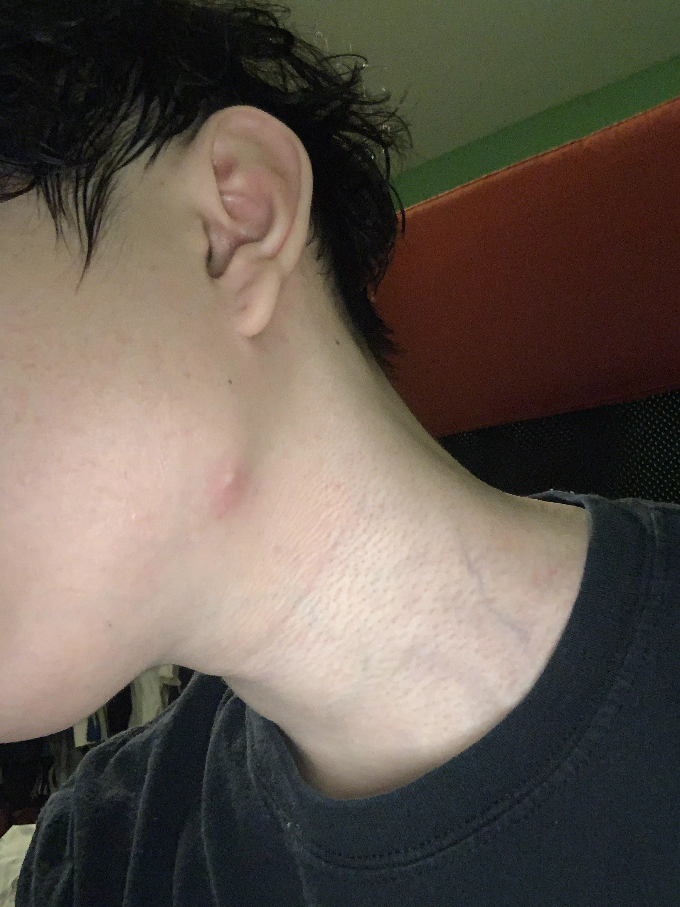 Help! Doctor said I could try popping this cyst. I couldn't pop it and now it's all red and sore.