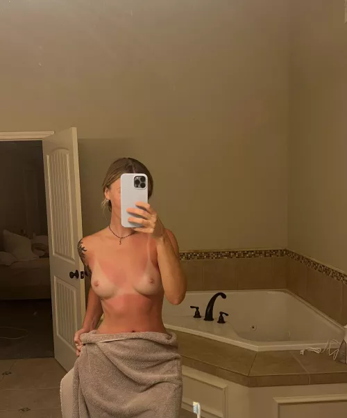 Hoping this burn turns into a tan hehe