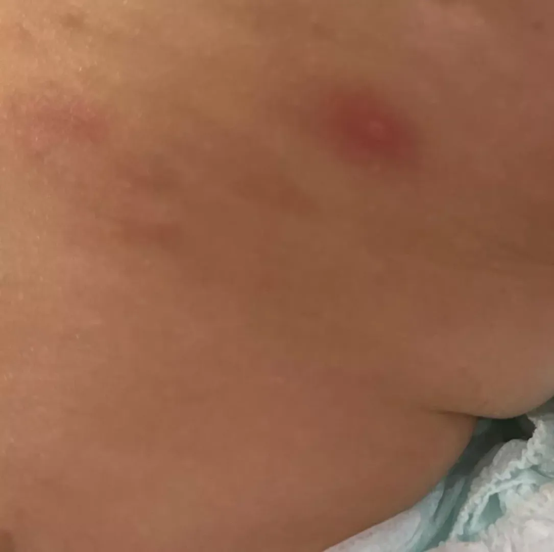 How many days do abscess continue feeling hard and a little red after draining ?