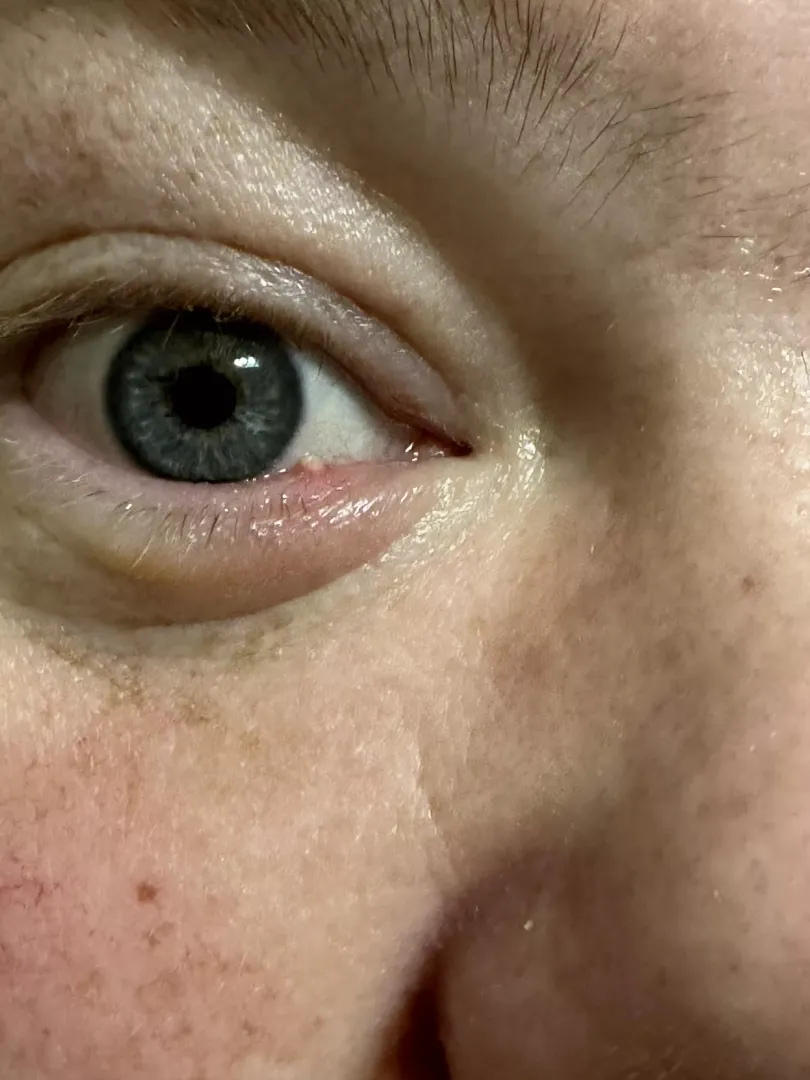 Hubby’s stye is coming to head
