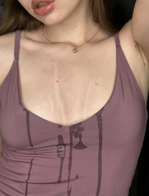 I had my cleavage filled