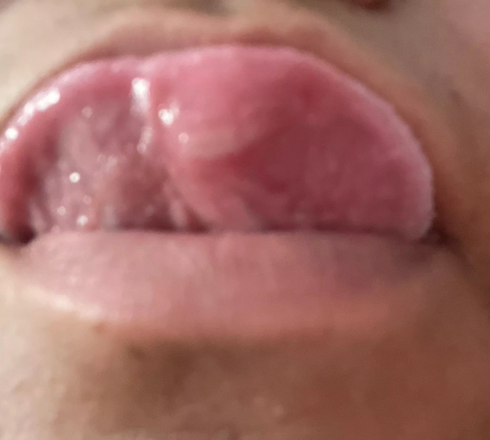 I had thyroid surgery yesterday and idk if I bit my tongue…