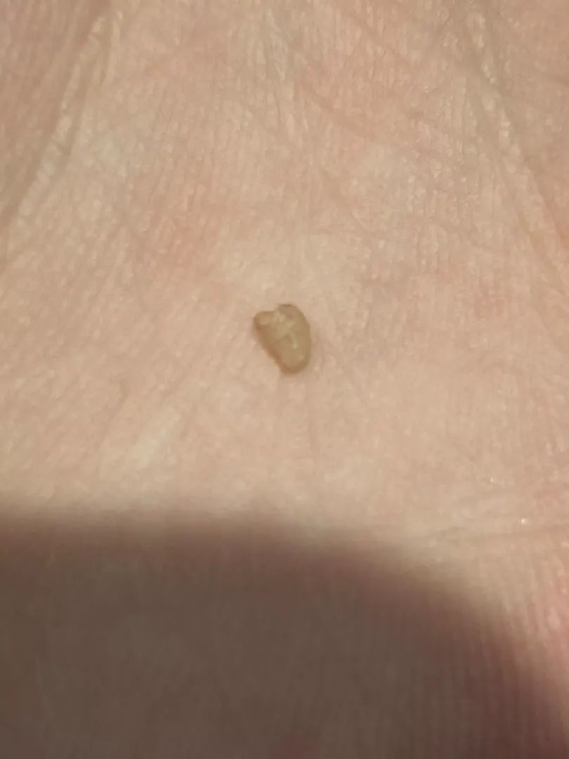 I popped and pulled this out of what started as an ingrown hair on my private part… any idea what it is? A cyst? 