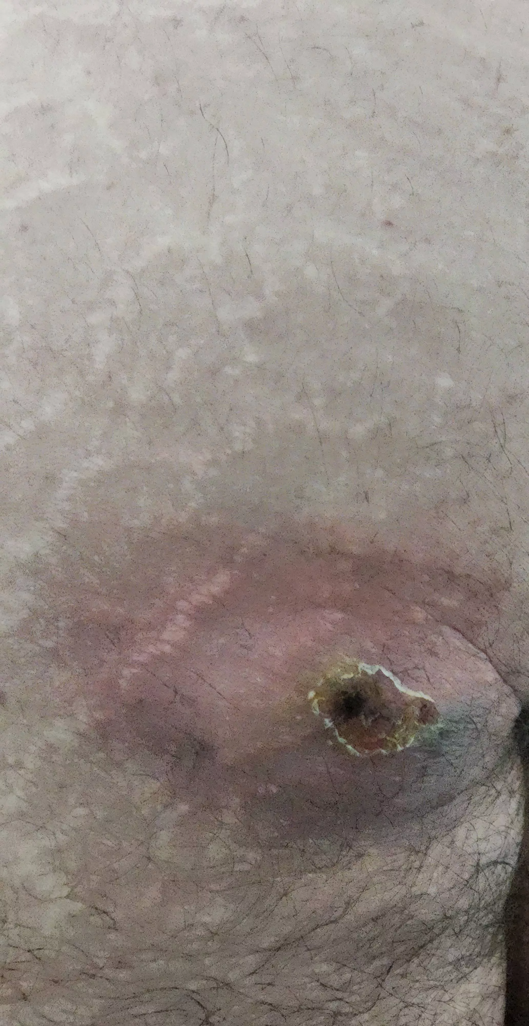 I think I have a cyst