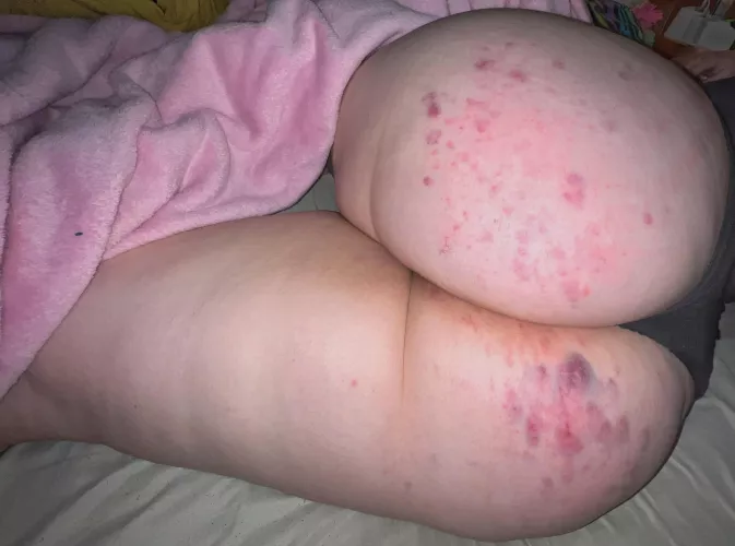 i. want. more. bruises.