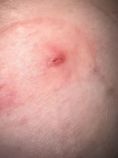 ingrown hair on my side turned into a monster! disclaimer: redness around the site is due to adhesive reaction from a bandaid