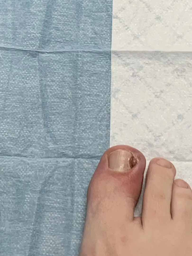 Ingrown toenail with staph